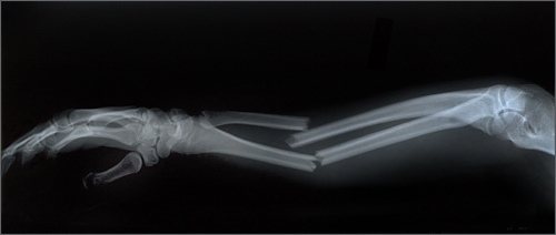 compensation for broken arm